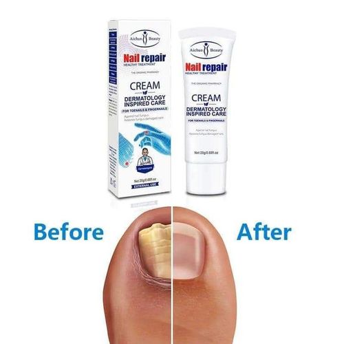 CREMA ANTIHONGOS DE UÑAS DE PIES Y MANOS