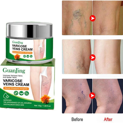 CREMA PARA LAS VARICES